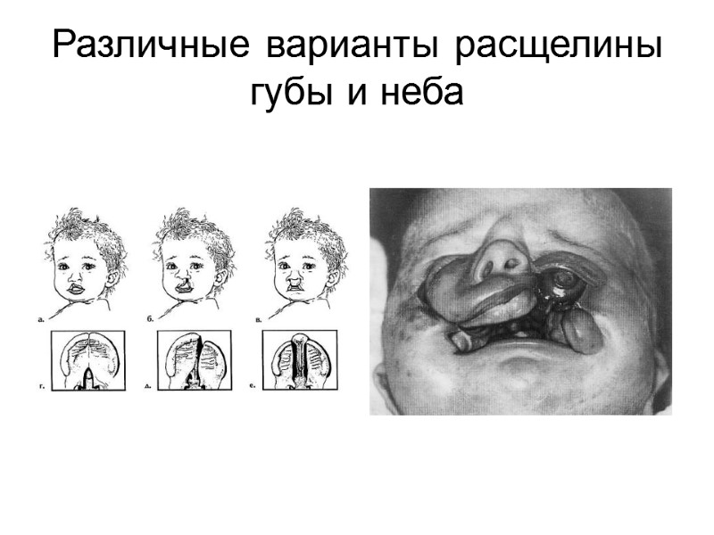 Различные варианты расщелины губы и неба